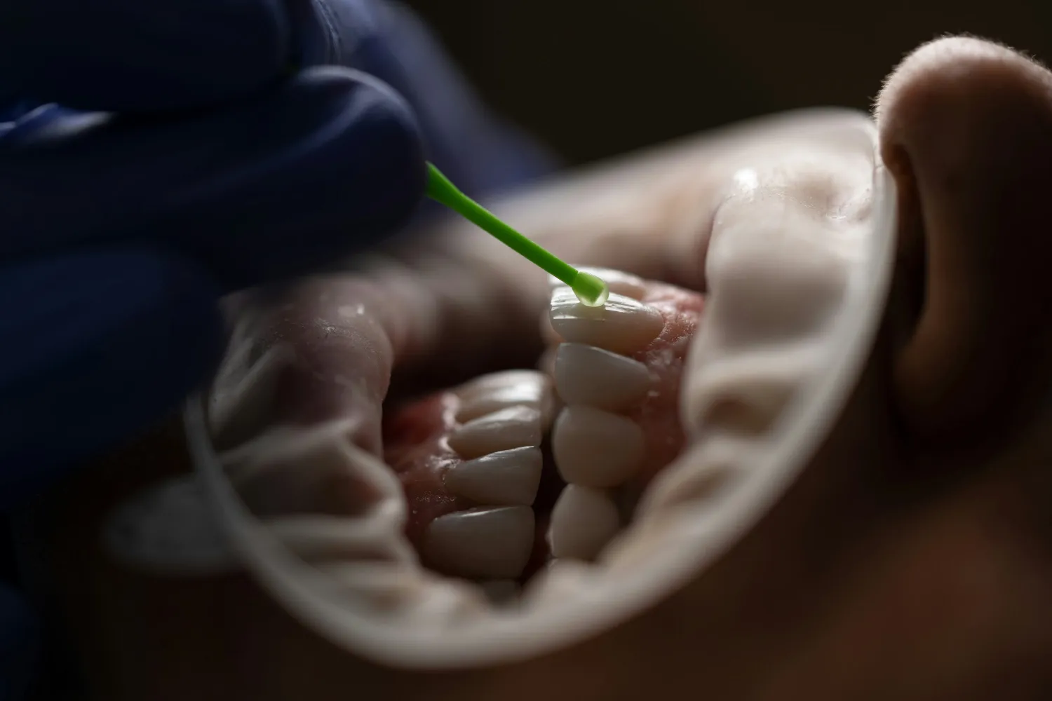 Cosmetic dentistry smile makeover NYC